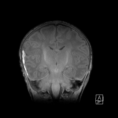 Bilateral subdural hemorrhage and parietal skull fracture (Radiopaedia 26058-26190 Coronal T1 30).png
