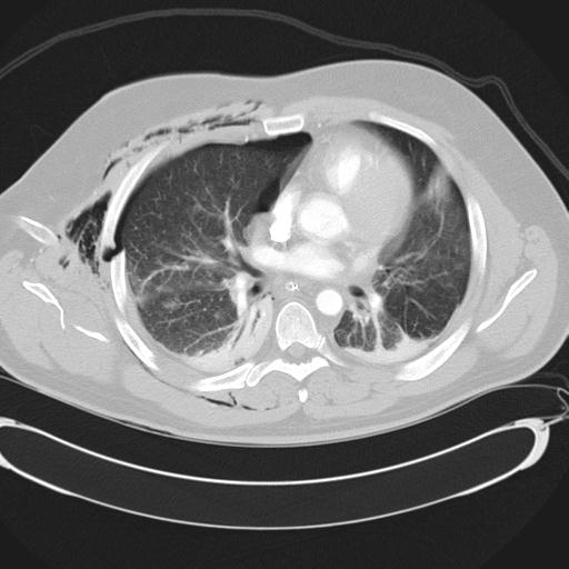 Bilateral traumatic renovascular injury (Radiopaedia 32051-32995 Axial lung window 28).jpg