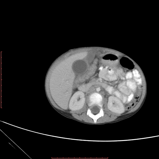 Biliary tract embryonal rhabdomyosarcoma (Radiopaedia 51815-57648 A 64).jpg