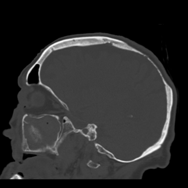 Biparietal osteodystrophy (Radiopaedia 46109-50463 Sagittal bone window 71).jpg
