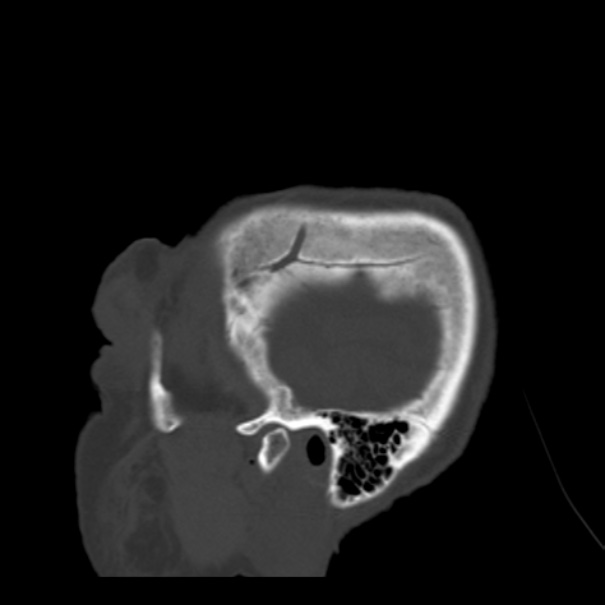 Biparietal osteodystrophy (Radiopaedia 46109-50463 Sagittal bone window 94).jpg