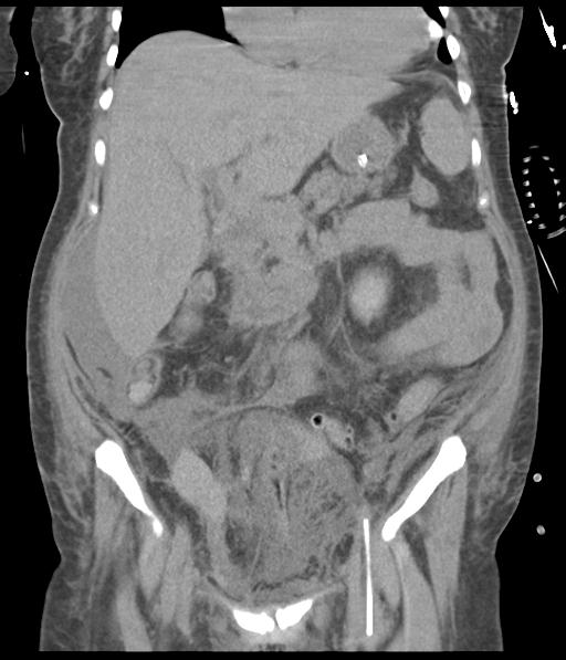 Bladder rupture post renal biopsy (Radiopaedia 30863-31572 Coronal non-contrast 27).jpg