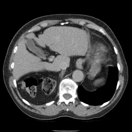 Bladder tumor detected on trauma CT (Radiopaedia 51809-57609 C 31).jpg