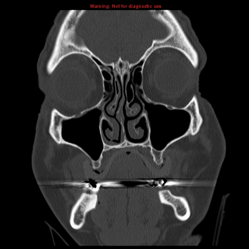 File:Blowout fracture with inferior rectus entrapment (Radiopaedia 12418-12673 Coronal bone window 3).jpg