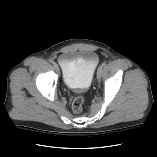 File:Blunt abdominal trauma with solid organ and musculoskelatal injury with active extravasation (Radiopaedia 68364-77895 Axial C+ delayed 121).jpg