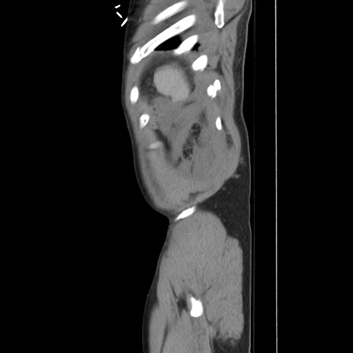 Blunt abdominal trauma with solid organ and musculoskelatal injury with active extravasation (Radiopaedia 68364-77895 C 130).jpg