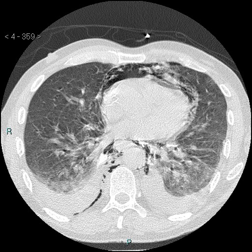 Boerhaave syndrome (Radiopaedia 27683-27897 lung window 59).jpg