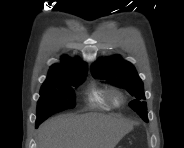 File:Boerhaave syndrome (Radiopaedia 39382-41660 C 19).png