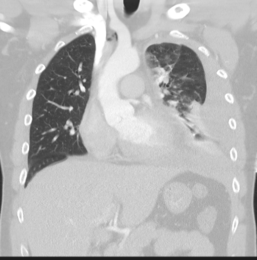 Boerhaave syndrome (Radiopaedia 39382-41661 Coronal lung window 20).png