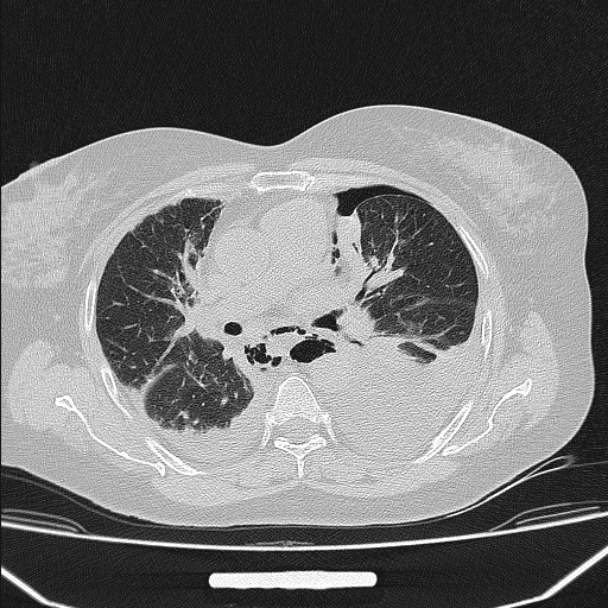 Boerhaave syndrome (Radiopaedia 45644-49799 Axial lung window 60).jpg