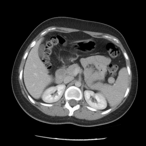 File:Borderline mucinous tumor (ovary) (Radiopaedia 78228-90808 A 78).jpg