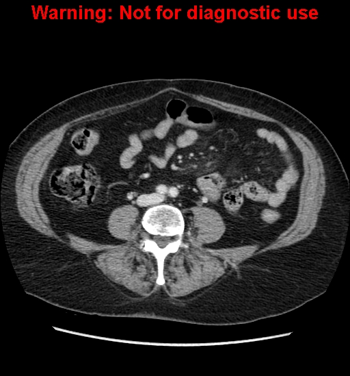 File:Bosniak renal cyst - type II (Radiopaedia 23404-23468 D 42).jpg