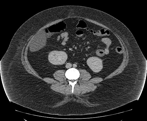 File:Bowel and splenic infarcts in acute lymphocytic leukemia (Radiopaedia 61055-68913 A 74).jpg