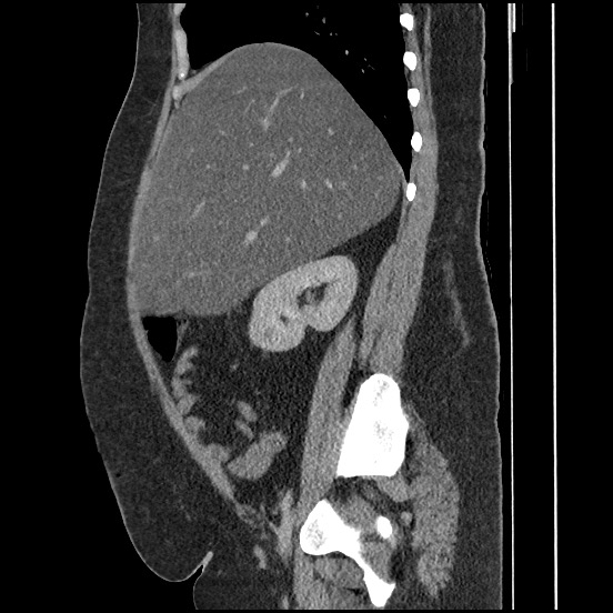 Bowel and splenic infarcts in acute lymphocytic leukemia (Radiopaedia 61055-68913 C 53).jpg