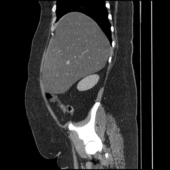 Bowel and splenic infarcts in acute lymphocytic leukemia (Radiopaedia 61055-68913 C 58).jpg