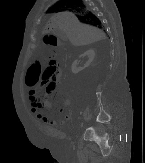Bowel ischemia secondary to SMA occlusion with extensive portomesenteric venous gas (Radiopaedia 54656-60871 Sagittal bone window 78).jpg