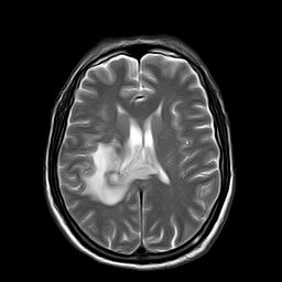 File:Brain abscess complicated by intraventricular rupture and ventriculitis (Radiopaedia 82434-96571 Axial T2 15).jpg