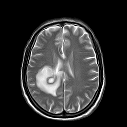 File:Brain abscess complicated by intraventricular rupture and ventriculitis (Radiopaedia 82434-96571 Axial T2 16).jpg