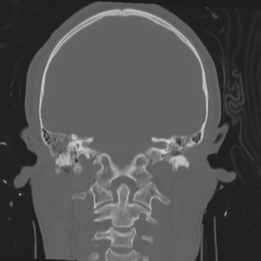 Brain contusions, internal carotid artery dissection and base of skull fracture (Radiopaedia 34089-35339 Coronal bone window 42).png