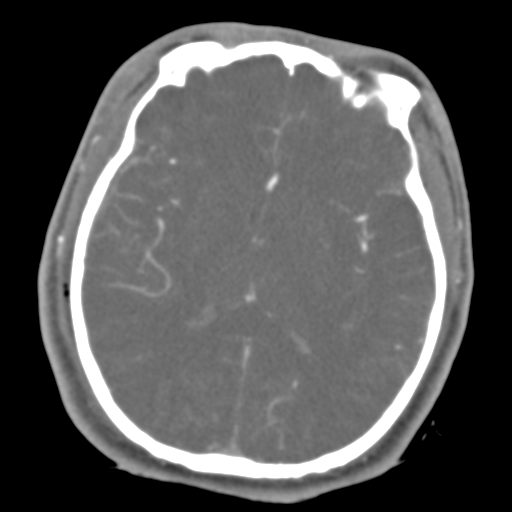 Brain contusions, internal carotid artery dissection and base of skull fracture (Radiopaedia 34089-35339 D 26).png