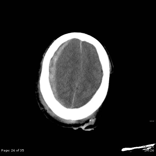 File:Brain death after motor vehicle collision (Radiopaedia 88470-105114 Axial non-contrast 26).jpg