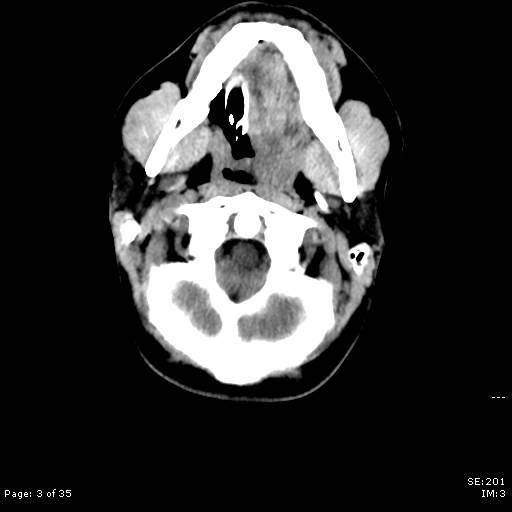 File:Brain death after motor vehicle collision (Radiopaedia 88470-105114 Axial non-contrast 3).jpg