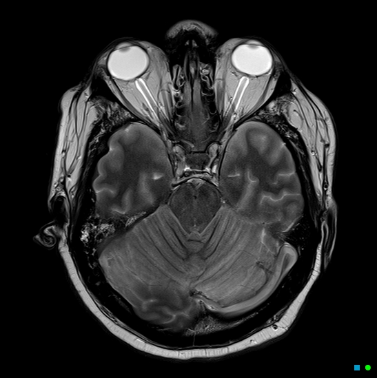 File:Brain death on MRI and CT angiography (Radiopaedia 42560-45689 Axial T2 12).jpg