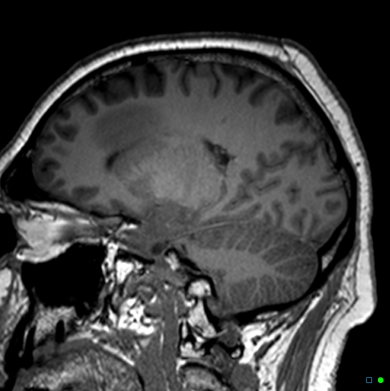 Brain death on MRI and CT angiography (Radiopaedia 42560-45689 Sagittal T1 7).jpg