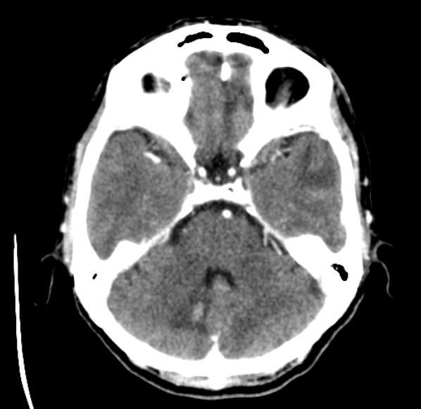 File:Brain metastases from lung cancer (Radiopaedia 24480-24781 Axial C+ delayed 15).jpg
