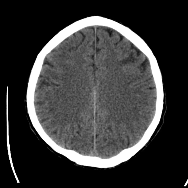 Brain metastases from lung cancer (Radiopaedia 24480-24781 Axial non-contrast 34).jpg