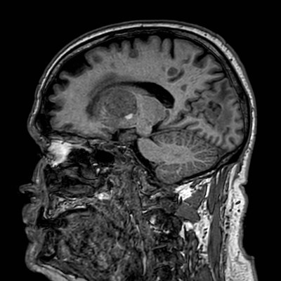 Brain metastases from lung cancer (Radiopaedia 83839-99028 Sagittal T1 51).jpg