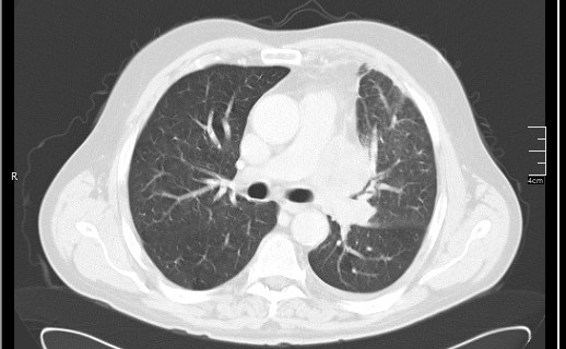 Brain metastases from squamocellular lung cancer (Radiopaedia 56515-63219 Axial lung window 30).jpg