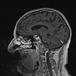 Brain metastasis (Radiopaedia 42617-45761 Sagittal T1 C+ 55).jpg