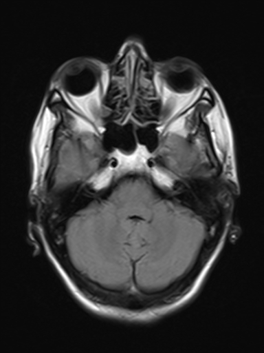 File:Brain metastasis as initial presentation of non-small cell lung cancer (Radiopaedia 65122-74126 Axial FLAIR 6).jpg