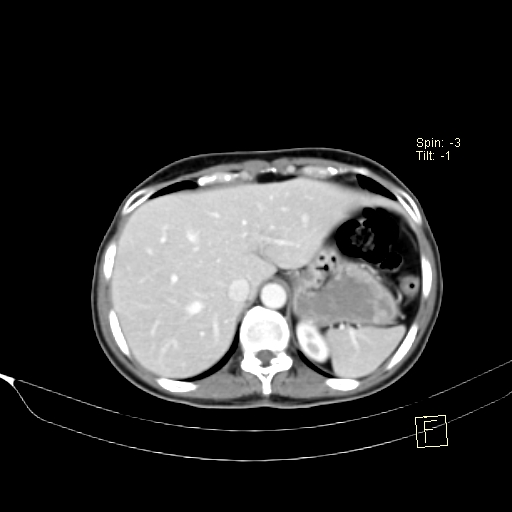 Brain metastasis as initial presentation of non-small cell lung cancer (Radiopaedia 65122-74127 A 44).jpg