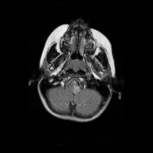 File:Brainstem ganglioglioma (Radiopaedia 10763-11224 Axial FLAIR 17).jpg
