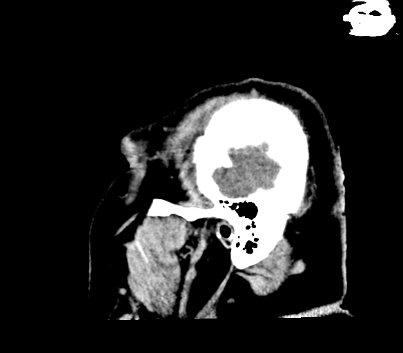 Brainstem hemorrhage (Radiopaedia 81294-94976 C 3).jpg