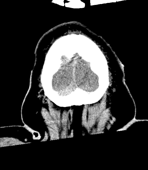 Brainstem hemorrhage (Radiopaedia 81294-94976 Coronal non-contrast 64).jpg