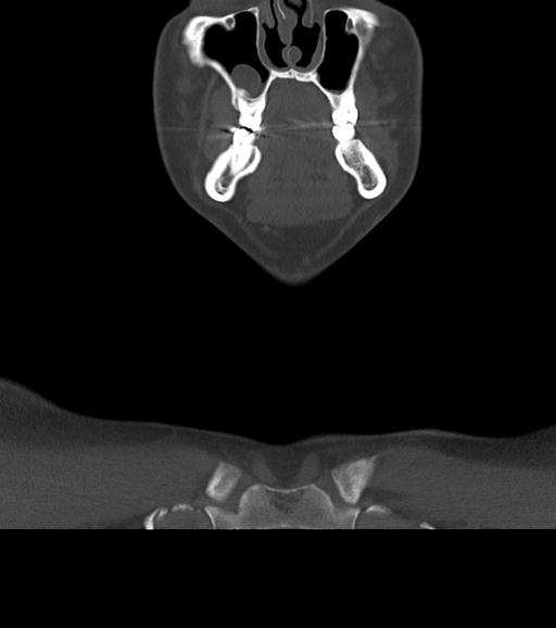 Branchial cleft cyst (Radiopaedia 31167-31875 Coronal bone window 17).jpg