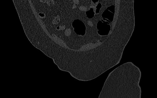 File:Breast carcinoma with pathological hip fracture (Radiopaedia 60314-67993 Coronal bone window 35).jpg