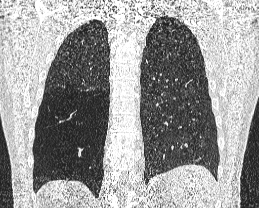 File:Bronchial atresia (Radiopaedia 58271-65417 Coronal lung window 46).jpg