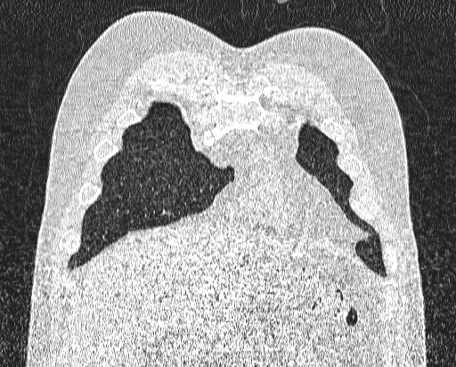 Bronchial atresia (Radiopaedia 58271-65417 Coronal lung window 6).jpg