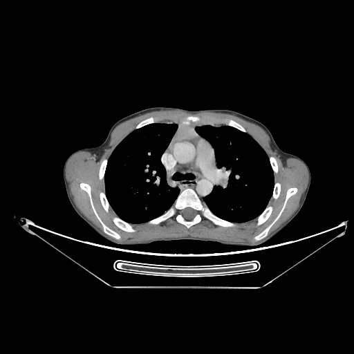 Bronchial carcinoid tumor (Radiopaedia 57187-64090 A 24).jpg
