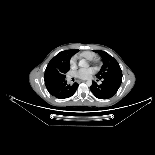 Bronchial carcinoid tumor (Radiopaedia 57187-64090 A 41).jpg