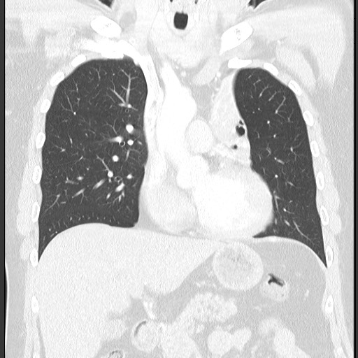 Bronchial carcinoid tumor (Radiopaedia 67377-76764 Coronal lung window 31).jpg
