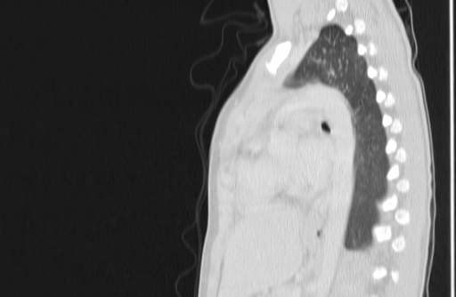 Bronchial mucoepidermoid carcinoma (Radiopaedia 57023-63895 Sagittal lung window 108).jpg
