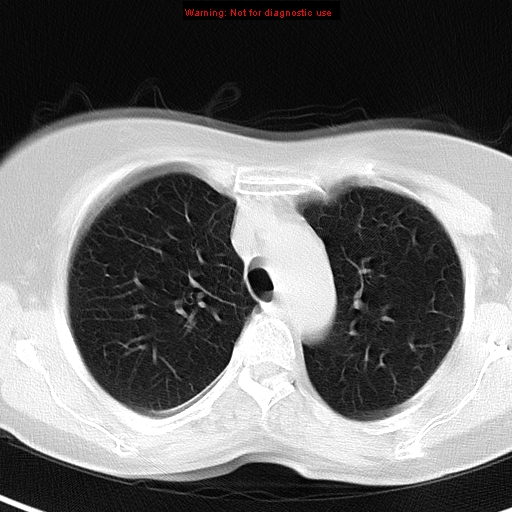 File:Bronchoalveolar carcinoma (BAC) (Radiopaedia 13436-13392 Axial lung window 14).jpg