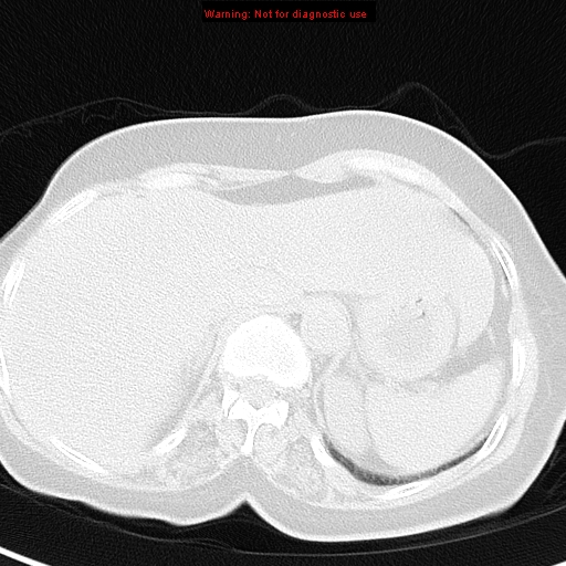 File:Bronchoalveolar carcinoma (BAC) (Radiopaedia 13436-13392 Axial lung window 46).jpg