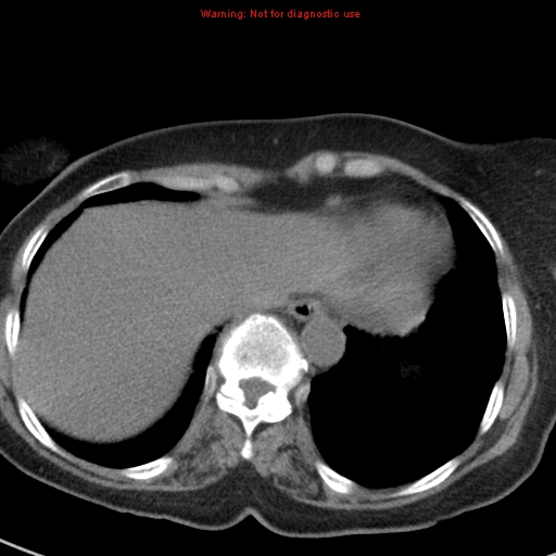 File:Bronchoalveolar carcinoma (BAC) (Radiopaedia 13436-13392 Axial non-contrast 42).jpg