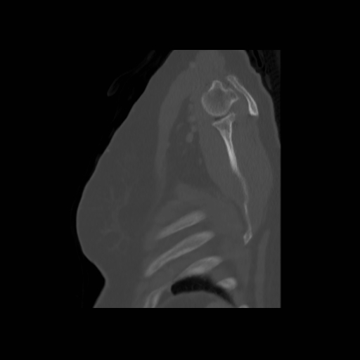 Bronchogenic carcinoma (Radiopaedia 73497-84262 Sagittal bone window 138).jpg